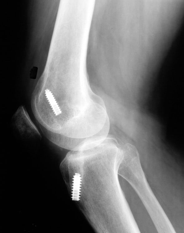 Knee Injury Lawyer In Nevada Workers' Compensation Coverage For Nevada Knee Injuries